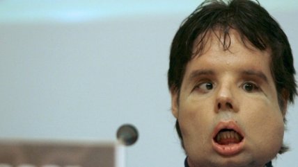   Paciente trasplantado de rostro está feliz y cómodo con su nueva apariencia 