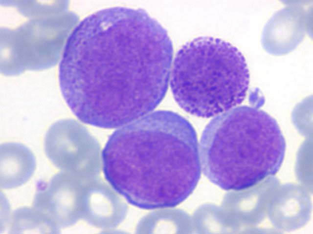 Nueva terapia celular proyecta exterminar la leucemia en ocho días Nueva terapia celular proyecta exterminar la leucemia en ocho días