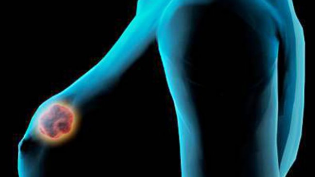 Descubren que proteína frena cáncer de mama y metástasis de pulmón