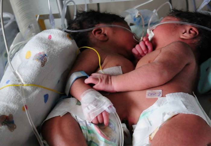 Joven dio a luz a siamesas unidas por el corazón e hígado Joven dio a luz a siamesas unidas por el corazón e hígado