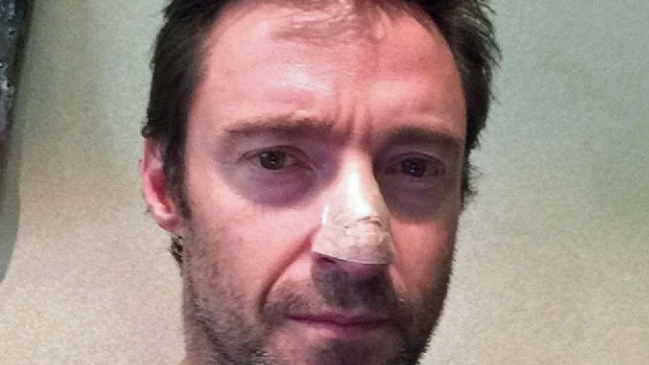 Hugh Jackman enfrenta tercera operación por cáncer de piel Hugh Jackman enfrenta tercera operación por cáncer de piel