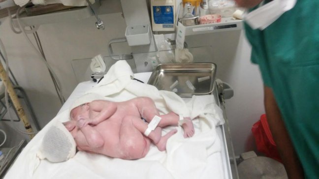 Siamesas unidas por el corazón nacieron en Talca Siamesas unidas por el corazón nacieron en Talca