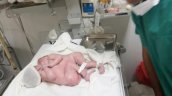 Fallecieron siamesas unidas por el corazón Fallecieron siamesas unidas por el corazón
