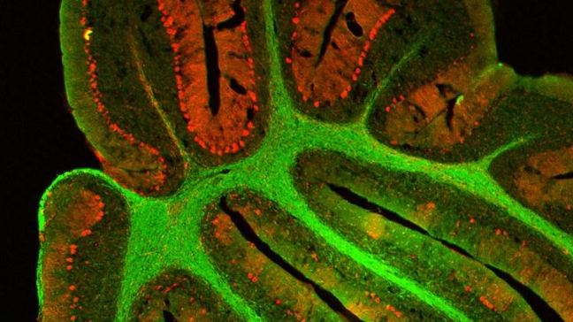 Identifican proteínas cuya supresión podría curar cánceres como la leucemia Identifican proteínas cuya supresión podría curar cánceres como la leucemia