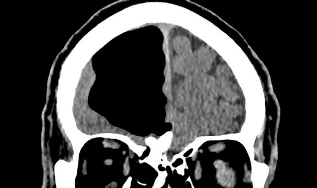 Médicos hallaron un hueco de aire en el cerebro de un hombre Médicos hallaron un hueco de aire en el cerebro de un hombre