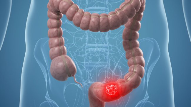 Mes de Concientización del Cáncer de Colon: Consejos para detectar y evitar la enfermedad