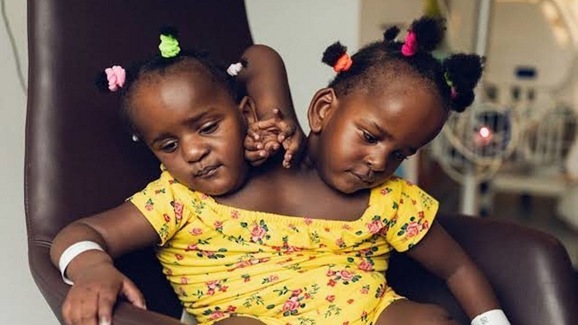 Padre decidió no separar a sus gemelas siamesas para evitar que una de ellas muera