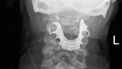  Se le perdió la dentadura postiza y estaba en su garganta  