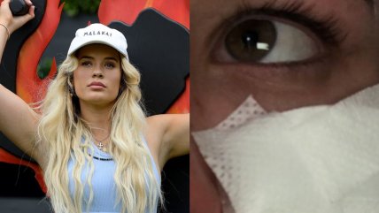  Influencer siguió tutorial de belleza de TikTok y se le quemó el rostro  