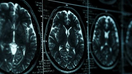  Nuevo ensayo confirma la eficacia de fármaco experimental contra el alzhéimer  