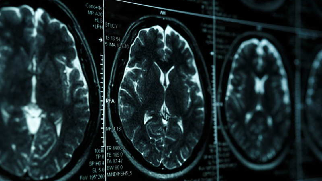 EE.UU. aprobó el uso de un medicamento que ralentiza los síntomas del alzheimer