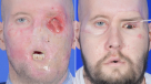 Hito médico: Paciente recibe exitoso primer trasplante de ojo completo Hito médico: Paciente recibe exitoso primer trasplante de ojo completo