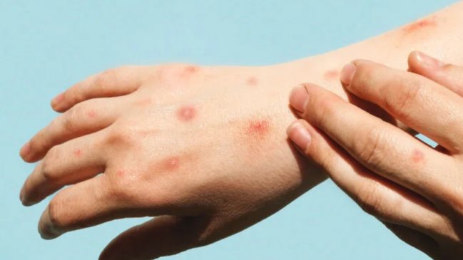 Cómo se transmite y cuáles son los síntomas del mpox o viruela del mono