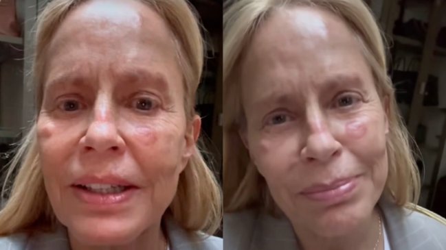 Cecilia Bolocco se baja de la Teletón por lesiones en su piel