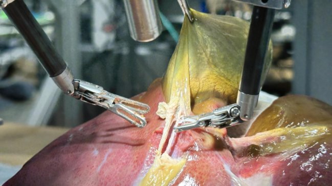 Robot cirujano entrenado con IA extirpó vesícula biliar con 100% de precisión