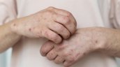 Por brote en Maule: Recomendaciones para prevenir la escarlatina