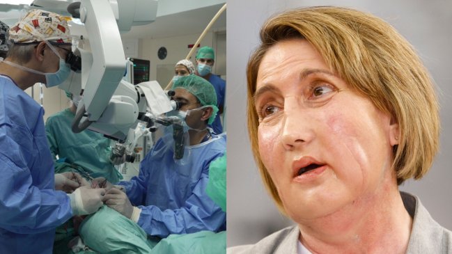 Barcelona: Inédito trasplante de cara con una donante que recibió la eutanasia