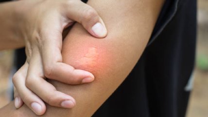   Cómo cuidar y prevenir las picaduras de zancudos y otros insectos 