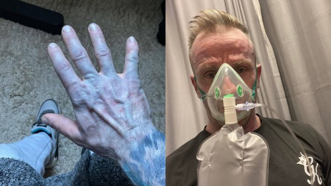 Hombre despertó completamente azul y terminó en urgencias: Motivo lo dejó en vergüenza